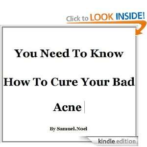 You Need To Know How To Cure Your Bad Acne samuel noel  