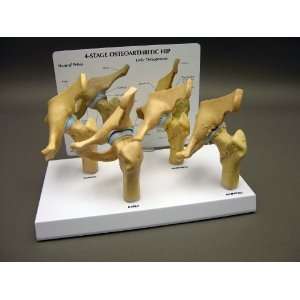 Hip Joint Arthritic 4 stage Model Set  Industrial 