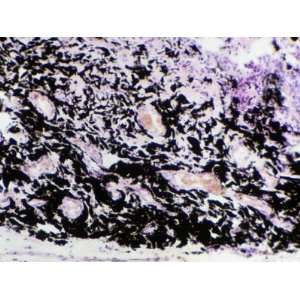 Cross Section of Lung Tissue from a Coal Miner Showing Large 