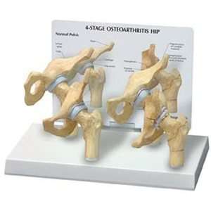   Arthritic Human Hip Joint Anatomy Model #1320 Industrial & Scientific